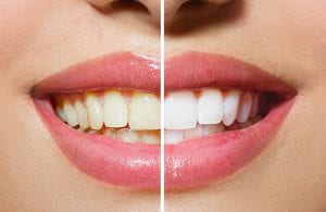 Saugus dantų balinimas odontologo kėdėje bei namuose pagal odontologo instrukciją