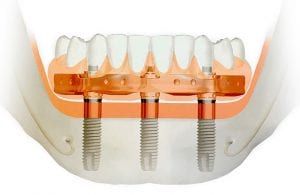 Apatinio bedančio žandikaulio dantų implantavimas per 6-8 val. ant 3-jų dantų implantų originalia švediška sistema