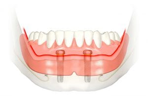 Tradiciniai dantų protezai, pritvirtinti ant 2-jų dantų implantų, užtikrina visišką stabilumą ir netrina gomurio