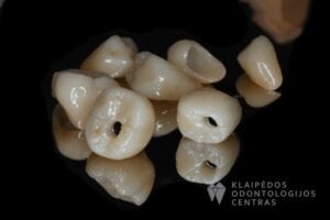 implantu-protezavimas-cirkonio-keramika-21