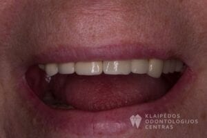 implantu-protezavimas-cirkonio-keramika-46